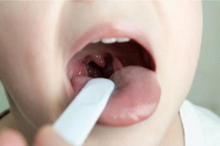 Giải pháp trị viêm amidan cho trẻ từ lợi khuẩn hô hấp trong Subavax