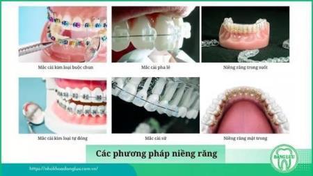 Niềng răng giá bao nhiêu? Vì sao nên niềng răng tại Nha Khoa Đăng Lưu