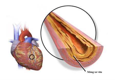 7 nhóm người dễ bị nhồi máu cơ tim, đột quỵ nhất