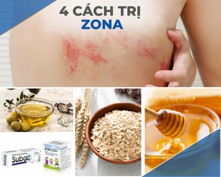 Mách bạn 4 cách trị zona tại nhà an toàn lại vô cùng hiệu quả!