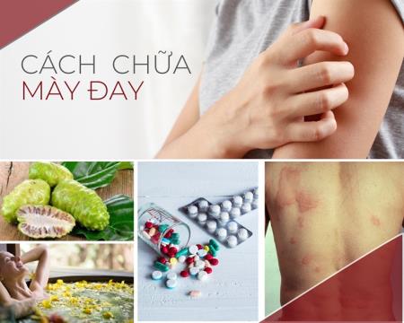 Mách bạn cách chữa mày đay, chấm dứt tình trạng ngứa “gãi toét da”!