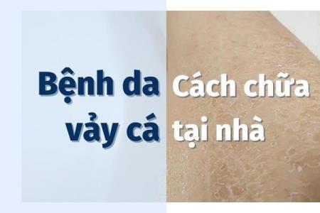 Bệnh da vảy cá và cách chữa hiệu quả ngay tại nhà