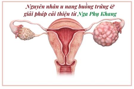 Nguyên nhân u nang buồng trứng và giải pháp cải thiện từ Nga Phụ Khang