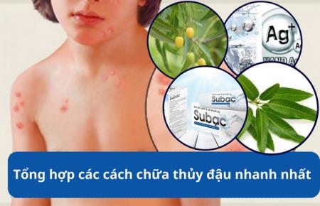 Tổng hợp các cách chữa thủy đậu nhanh nhất bằng thảo dược