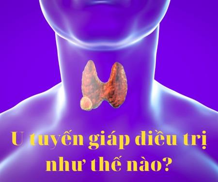 Điều trị u tuyến giáp sao cho đúng và hiệu quả?