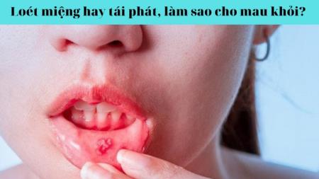 Loét miệng hay tái phát, làm sao cho mau khỏi?