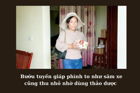 Bướu tuyến giáp: Cổ to như săm xe vẫn xẹp xuống nhờ cách này