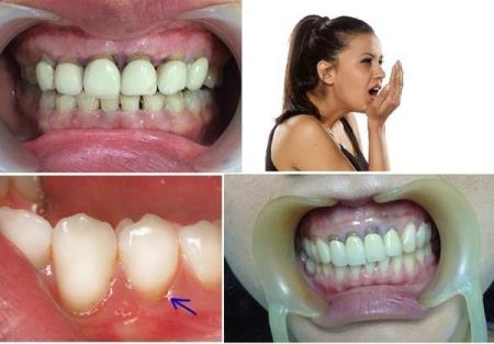 Bio Ceramic - Giải pháp triệt để cho thẩm mỹ nụ cười không biến chứng