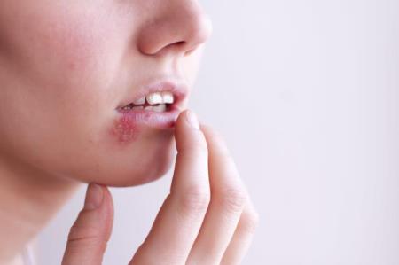 Cách chữa bệnh herpes môi nhanh nhất tại nhà