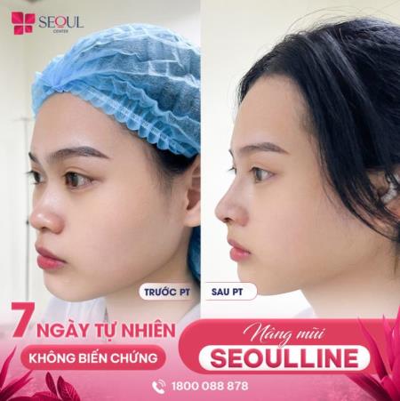 Nâng mũi sụn Surgiform có an toàn không? Những rủi ro có thể gặp phải