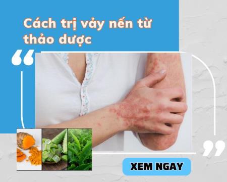 Cách trị vảy nến từ thảo dược không phải ai cũng biết